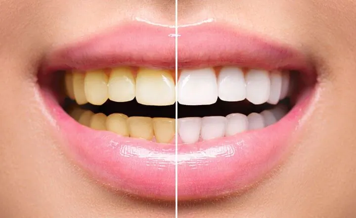 Zahnaufhellung mit Bleaching